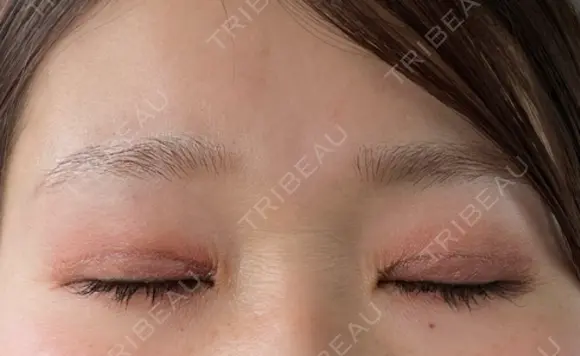 二重切開 / 目元修正 こまちクリニック DAY 154 メイン用