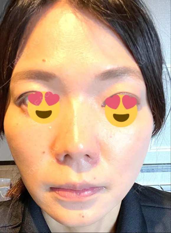 ボトックス（エラ・小顔） TCB東京中央美容外科 京都駅前院 AFTER メイン用