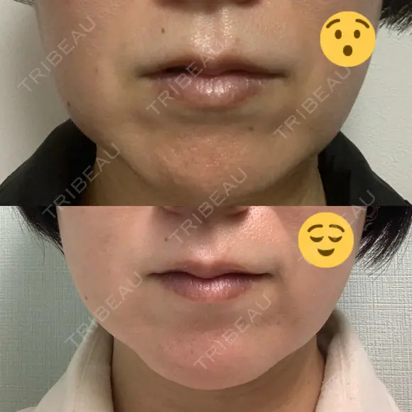 ボトックス（人中） ユウコ形成外科クリニック AFTER メイン用
