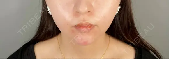 ボトックス（あご） / ヒアルロン酸注入（あご） ASTRA BEAUTY CLINIC DAY 0 メイン用