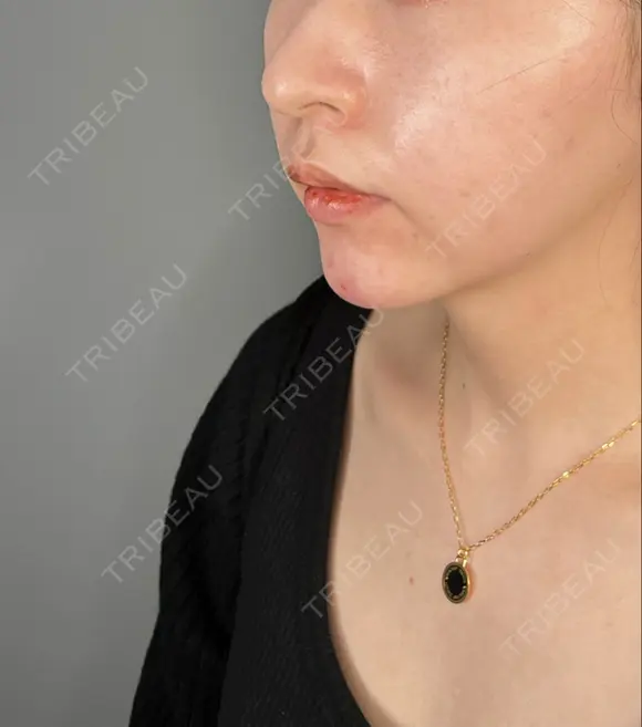 ボトックス（あご） / ヒアルロン酸注入（あご） ASTRA BEAUTY CLINIC DAY 0 メイン用