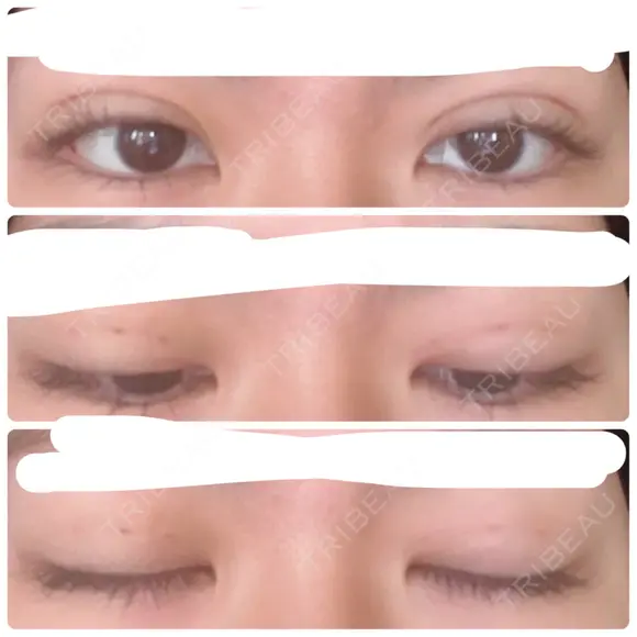 二重埋没 湘南美容クリニック 仙台院 DAY 3 メイン用