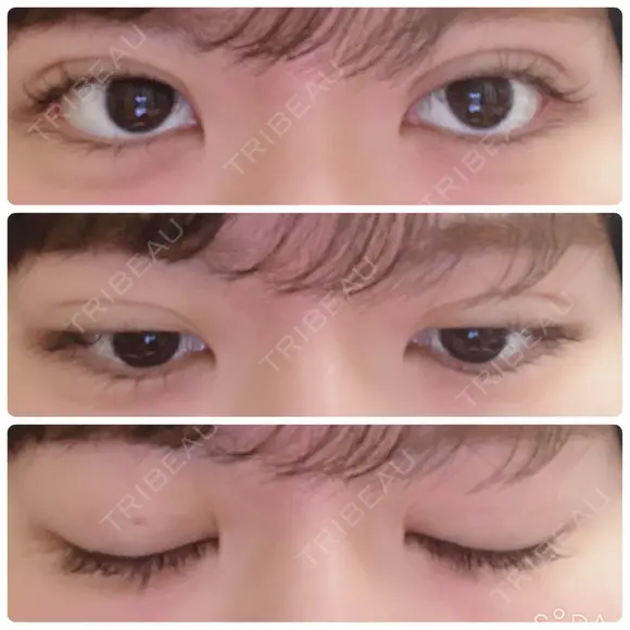 二重埋没 湘南美容クリニック 仙台院 DAY 5 メイン用