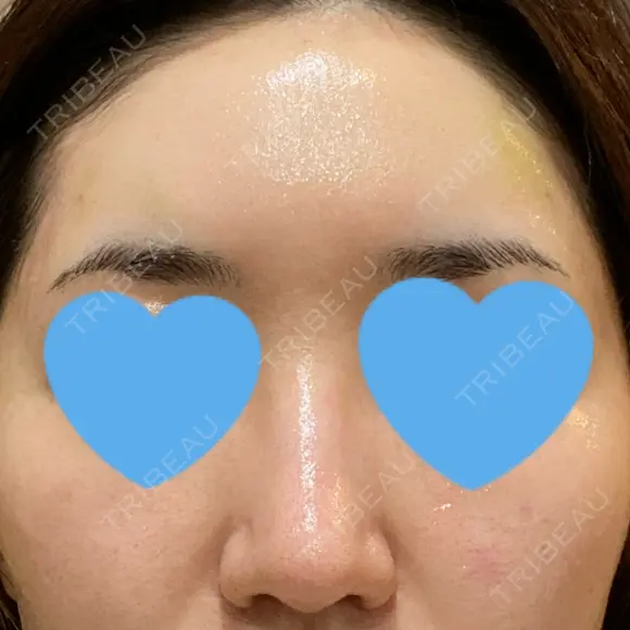 ヒアルロン酸注入（額） / ヒアルロン酸注入（こめかみ） LA CLEF CLINIC（ラクレクリニック） DAY 3 メイン用