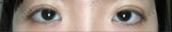 二重埋没 オーキッド美容クリニック東京御徒町 DAY 7 メイン用