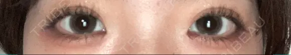 二重埋没 オーキッド美容クリニック東京御徒町 AFTER メイン用