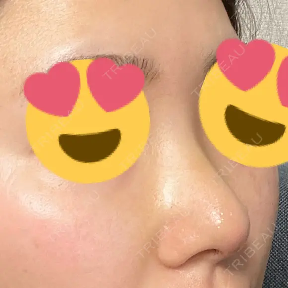 その他（鼻） / 軟骨移植 / 鼻尖形成（非切開） WOM CLINIC GINZA （ワム クリニック ギンザ） DAY 4 メイン用