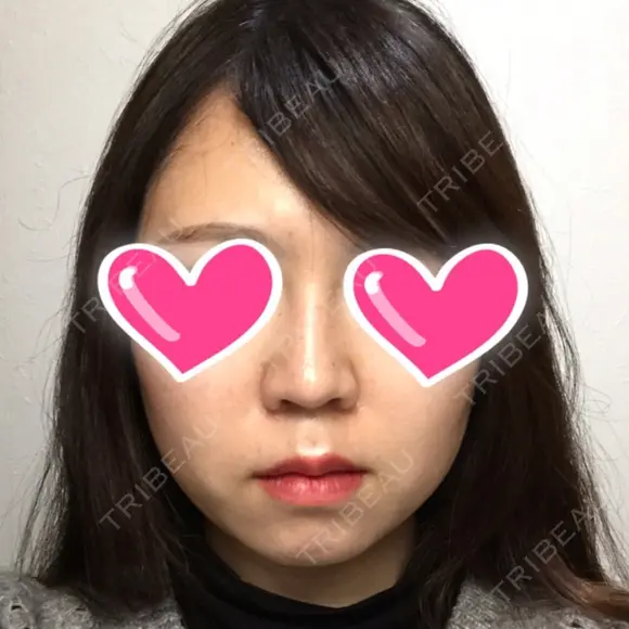 隆鼻術 / 鼻尖形成（切開） / 鼻中隔延長（切開） / 小鼻縮小（切開） ザ・プラス美容外科 DAY 100 メイン用