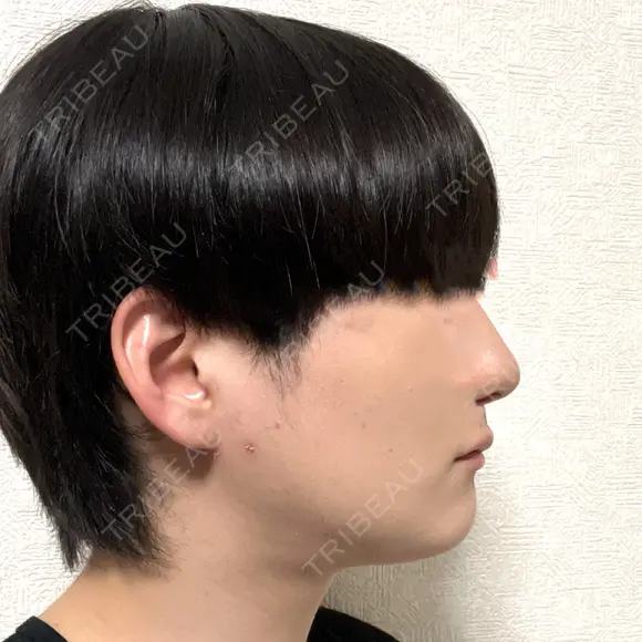 脂肪吸引（顔） 石倉クリニック 水戸院 DAY 20 メイン用