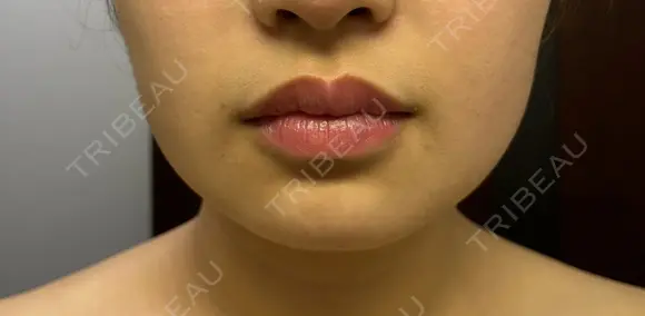 ボトックス（人中） 日比谷セントラルクリニック AFTER メイン用