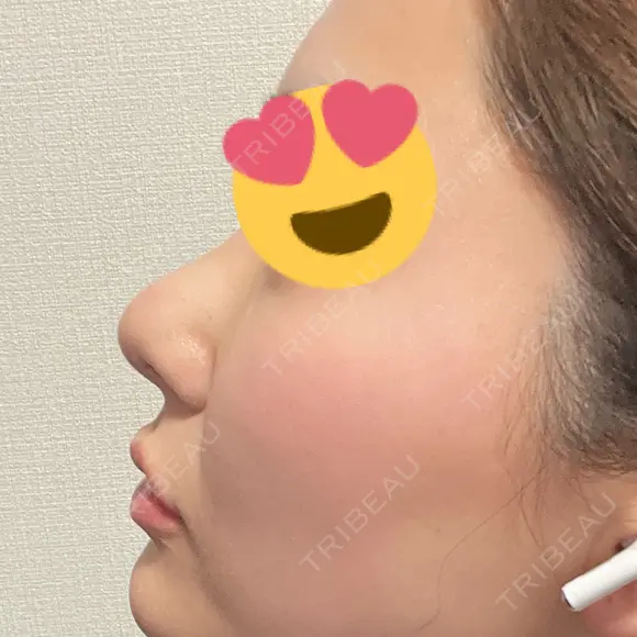 その他（鼻） / 軟骨移植 / 鼻尖形成（非切開） WOM CLINIC GINZA （ワム クリニック ギンザ） DAY 5 メイン用
