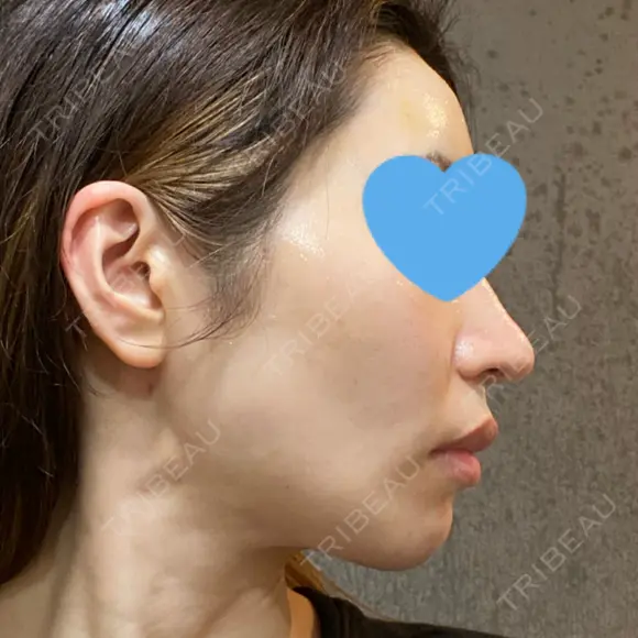 ヒアルロン酸注入（額） / ヒアルロン酸注入（こめかみ） LA CLEF CLINIC（ラクレクリニック） DAY 4 メイン用