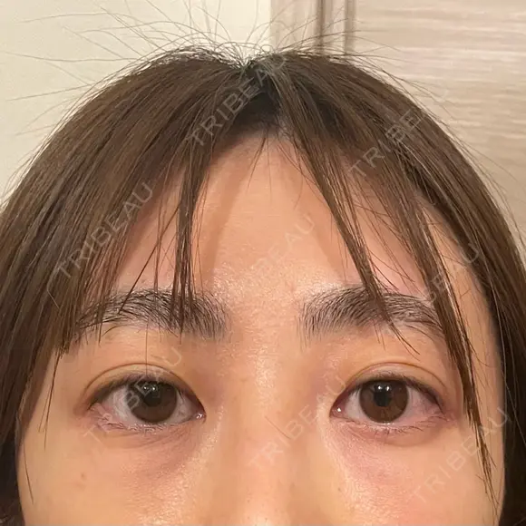 クマ治療 / 脂肪注入（目の下） / その他（目元） セオリークリニック DAY 28 メイン用