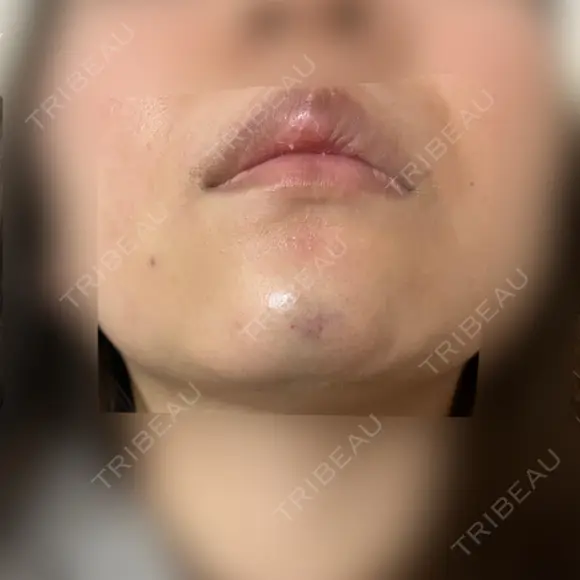 ボトックス（あご） / ヒアルロン酸注入（あご） / ボトックス（口角） / ボトックス（人中） / その他（口元） 表参道スキンクリニック 名古屋院（DAILY SKIN CLINIC提携院） DAY 2 メイン用