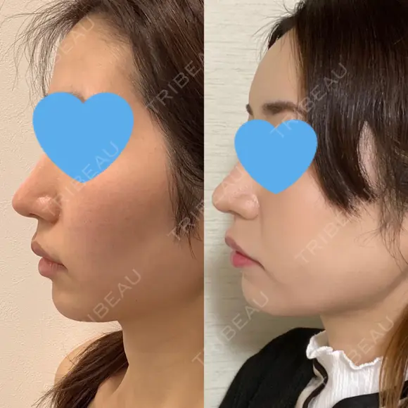 ヒアルロン酸注入（額） / ヒアルロン酸注入（こめかみ） LA CLEF CLINIC（ラクレクリニック） DAY 7 メイン用