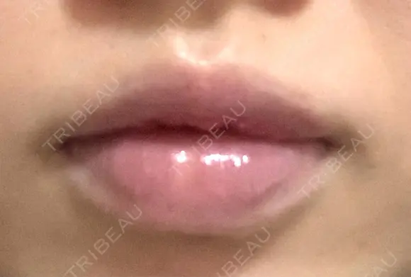 口唇縮小術 B-LINE CLINIC 池袋院 DAY 86 メイン用