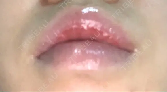 口唇縮小術 B-LINE CLINIC 池袋院 DAY 86 メイン用