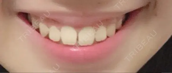 ガミースマイル手術 有楽町美容外科クリニック DAY 2 メイン用