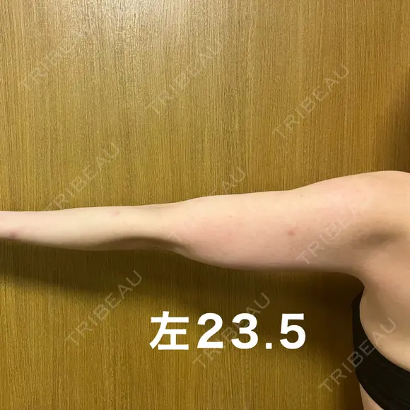 脂肪冷却（二の腕） みずほクリニック DAY 60 メイン用