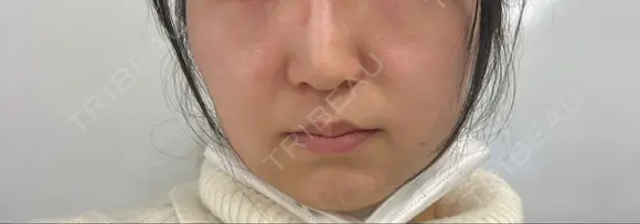 光治療（フォトフェイシャルなど） アムルーズ美容外科クリニック 大阪院 DAY 0 メイン用