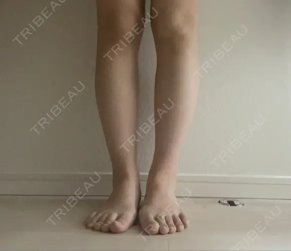 ボトックス（ふくらはぎ） LOUIS CLINIC 二子玉川院【ルイクリニック】 DAY 3 メイン用