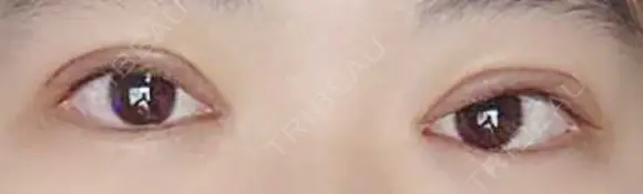 二重切開 松下皮フ形成外科 DAY 7 メイン用