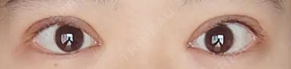 二重切開 松下皮フ形成外科 DAY 8 メイン用