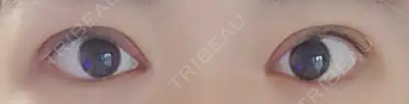 二重切開 松下皮フ形成外科 DAY 9 メイン用