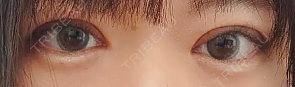 二重切開 松下皮フ形成外科 DAY 11 メイン用