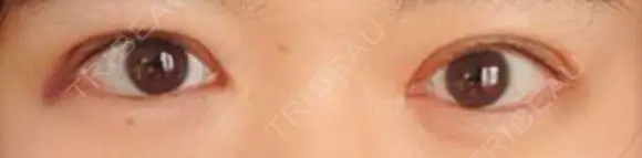 二重切開 松下皮フ形成外科 AFTER メイン用