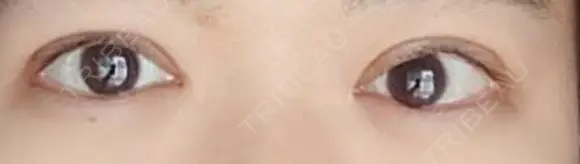 二重切開 松下皮フ形成外科 DAY 18 メイン用