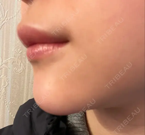 ヒアルロン酸注入（あご） 東京エビスクリニック DAY 1 メイン用