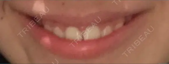 ガミースマイル手術 有楽町美容外科クリニック DAY 5 メイン用