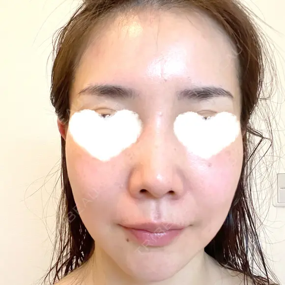 ハイフ（顔） 湘南美容クリニック 岡山院 DAY 7 メイン用