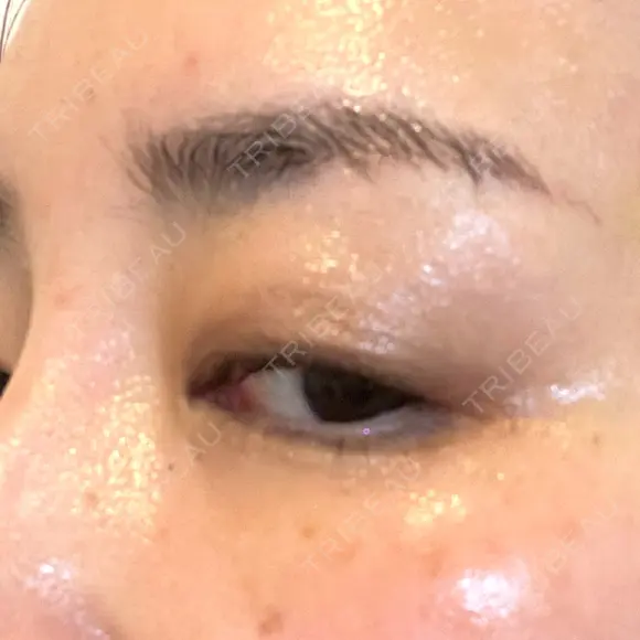 PRP皮膚再生療法 / その他（目元） ももスキンケアクリニック DAY 8 メイン用
