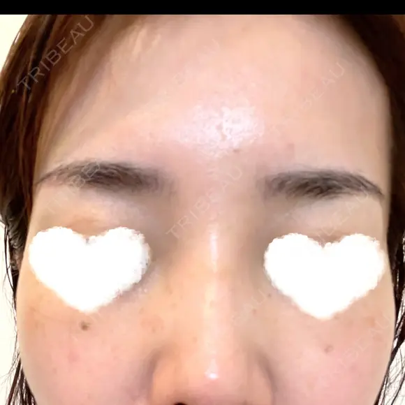 PRP皮膚再生療法 ももスキンケアクリニック DAY 8 メイン用