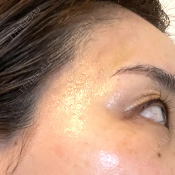 PRP皮膚再生療法 ももスキンケアクリニック DAY 8 メイン用