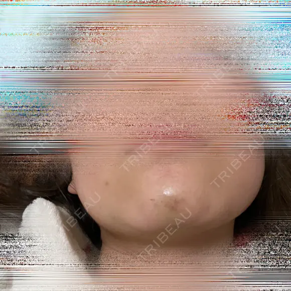 ボトックス（あご） / ヒアルロン酸注入（あご） / ボトックス（口角） / ボトックス（人中） / その他（口元） 表参道スキンクリニック 名古屋院（DAILY SKIN CLINIC提携院） AFTER メイン用