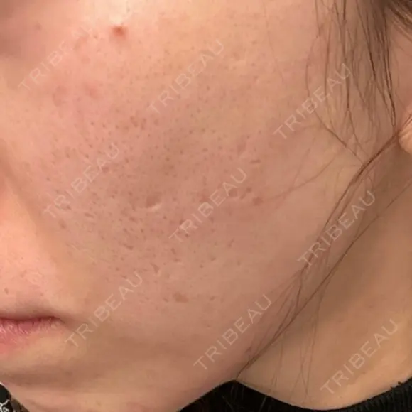 ピコフラクショナルレーザー（毛穴・ニキビ跡） CLINICA BellaForma DAY 0 メイン用