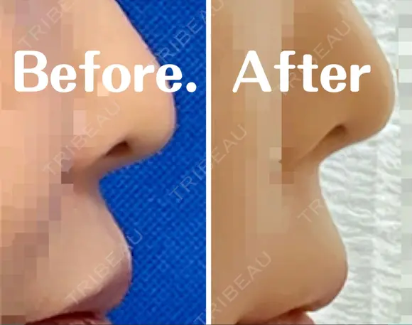 人中短縮 / 口角挙上 / ボトックス（口角） / ボトックス（人中） / その他（口元） eクリニック 金沢本院 AFTER メイン用