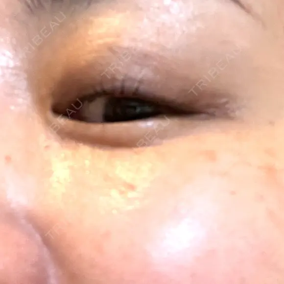 PRP皮膚再生療法 / その他（目元） ももスキンケアクリニック DAY 13 メイン用