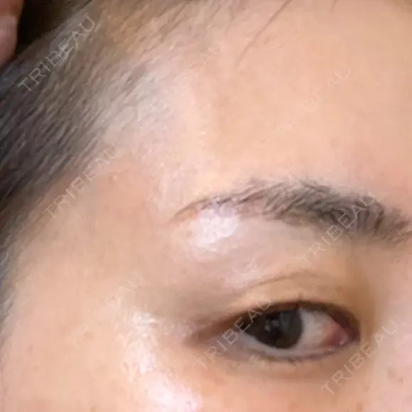 PRP皮膚再生療法 ももスキンケアクリニック DAY 13 メイン用