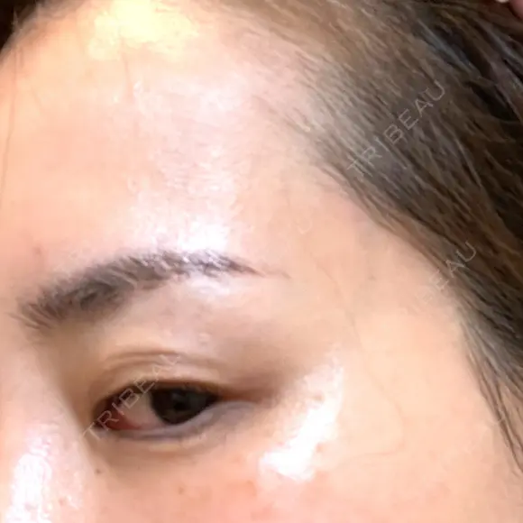 PRP皮膚再生療法 ももスキンケアクリニック DAY 13 メイン用