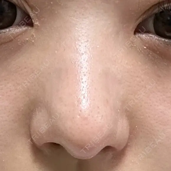 軟骨移植 / 鼻孔縁挙上 / 鼻尖縮小 くさのたろうクリニック AFTER メイン用