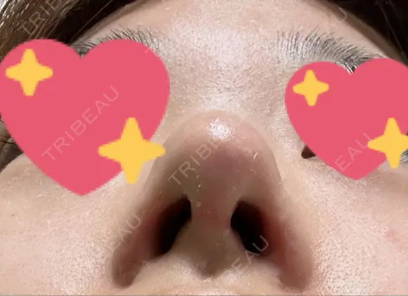 軟骨移植 / 鼻孔縁挙上 / 鼻尖縮小 くさのたろうクリニック DAY 32 メイン用