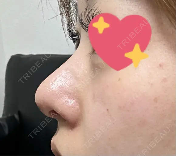 軟骨移植 / 鼻孔縁挙上 / 鼻尖縮小 くさのたろうクリニック DAY 32 メイン用