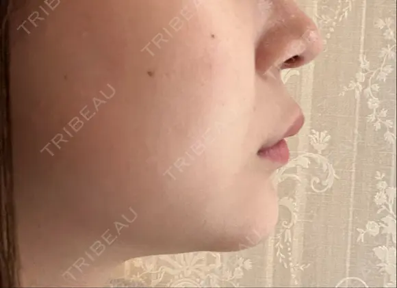 ヒアルロン酸注入（あご） 東京エビスクリニック DAY 2 メイン用