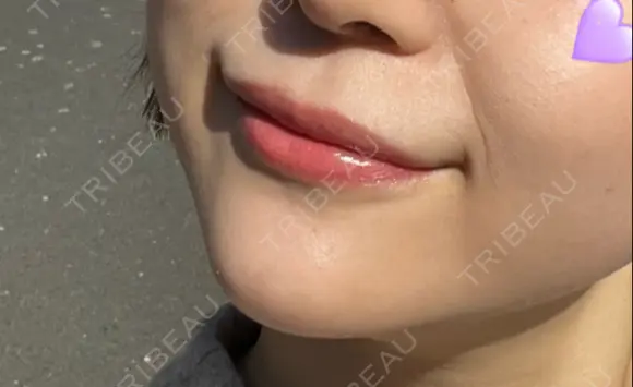 ヒアルロン酸注入（あご） 東京エビスクリニック DAY 3 メイン用