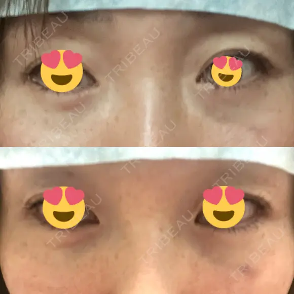 クマ治療 / 下まぶたの脂肪取り / ヒアルロン酸注入（目の下） / ボトックス（眉間） / ボトックス（目尻） / その他（鼻） YBC横浜美容外科 大宮院 DAY 1 メイン用