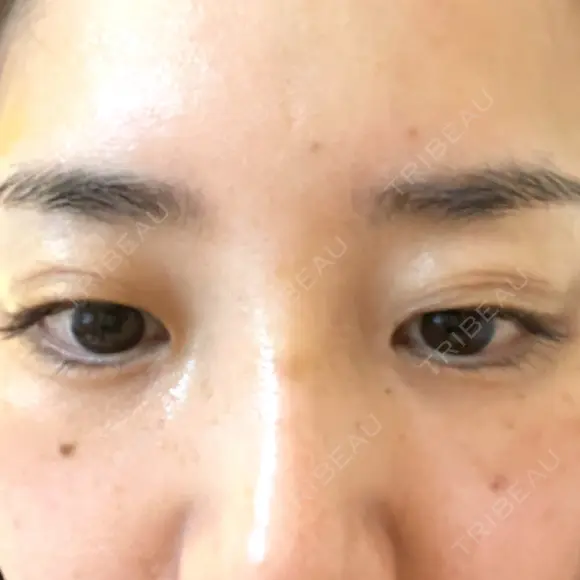 PRP皮膚再生療法 / その他（目元） ももスキンケアクリニック DAY 7 メイン用